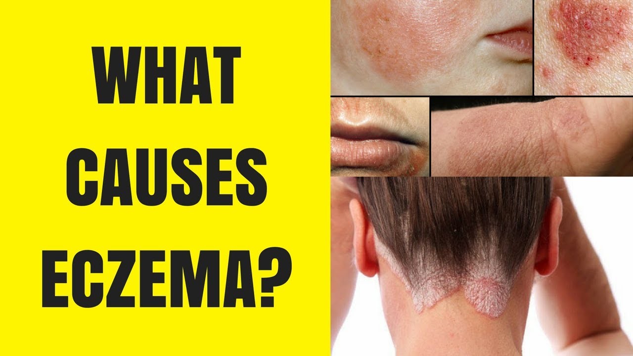 Eczema Facts